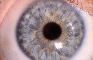 Corneal Cross Linking