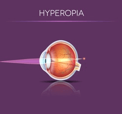What is Hyperopia and what causes it - LASIK For Farsightedness