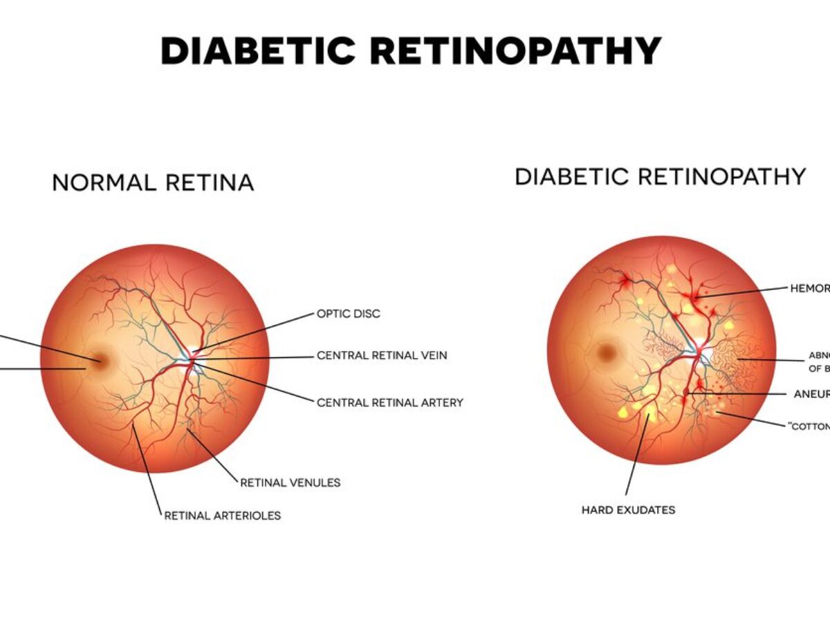 Diabetic Retinopathy Symptoms, & Treatments   Toledo LASIK